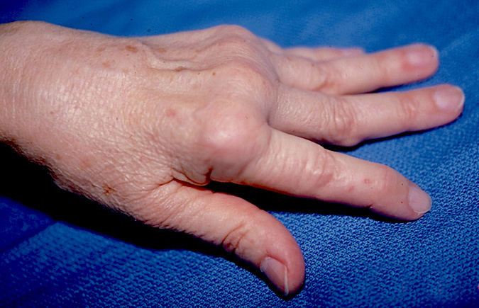 Rheumatoid Arthritis Hand Surgery Source 2616